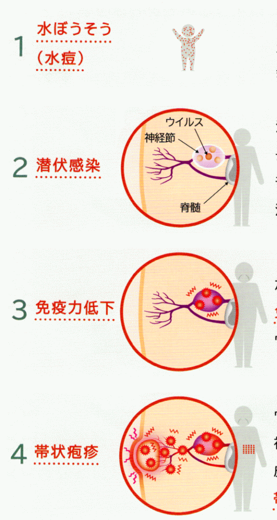 食事 治療 帯状 疱疹