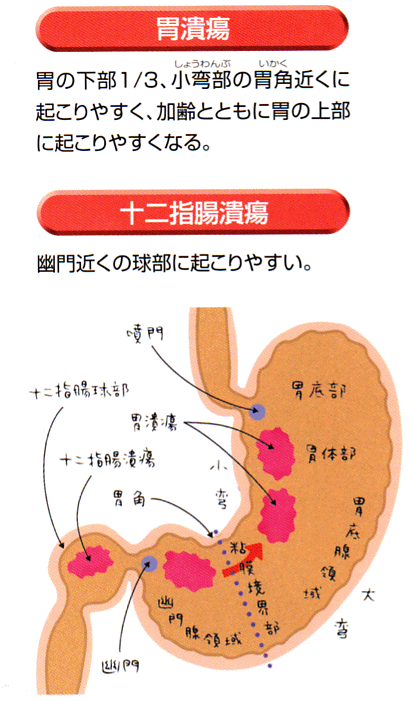 十二指腸 潰瘍 症状